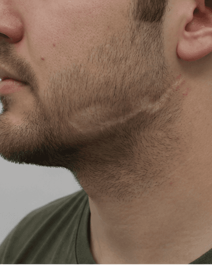 Scar Camouflage: before