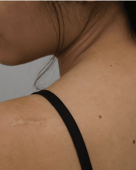 Scar Camouflage: before