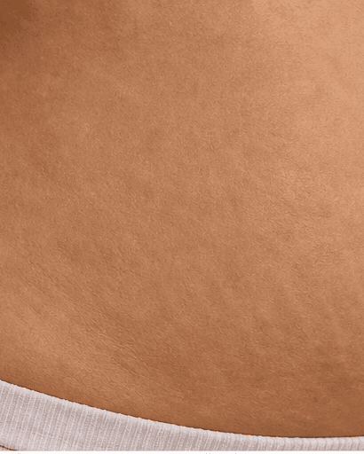 Mature Stretch Mark Treatment: after