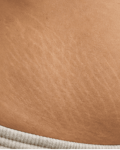 Mature Stretch Mark Treatment: before