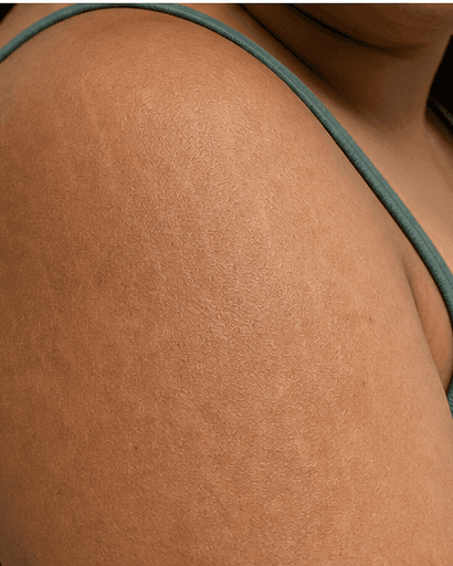 Mature Stretch Mark Treatment: after