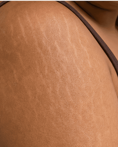 Mature Stretch Mark Treatment: before