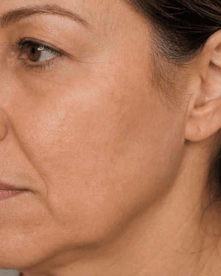 Surgical Scar Revision: after