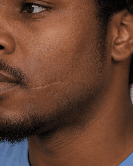 Surgical Scar Revision: before