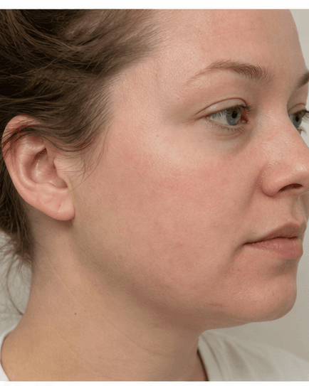 Eczema & Barrier Repair: after