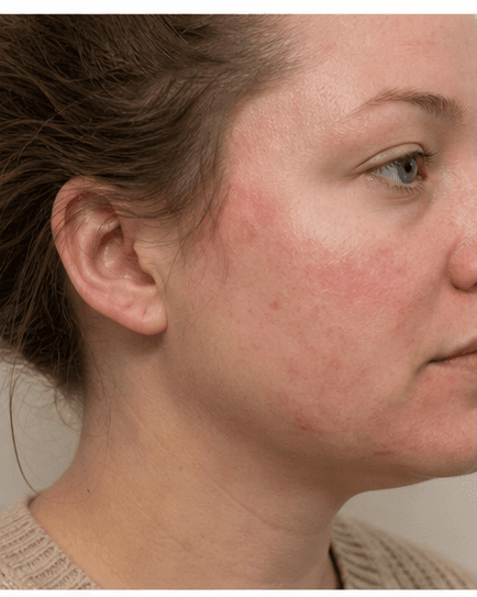 Eczema & Barrier Repair: before
