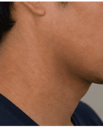 Eczema & Barrier Repair: after