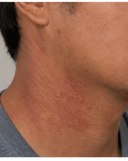 Eczema & Barrier Repair: before