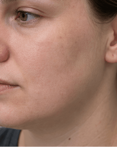 Eczema Management: after