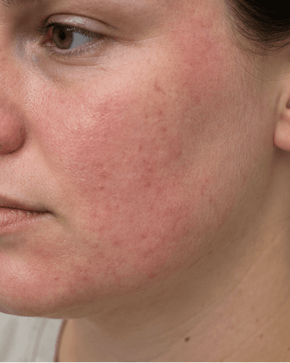 Eczema Management: before