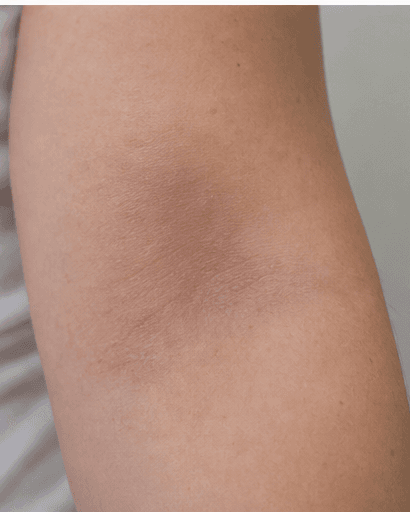 Eczema Management: after