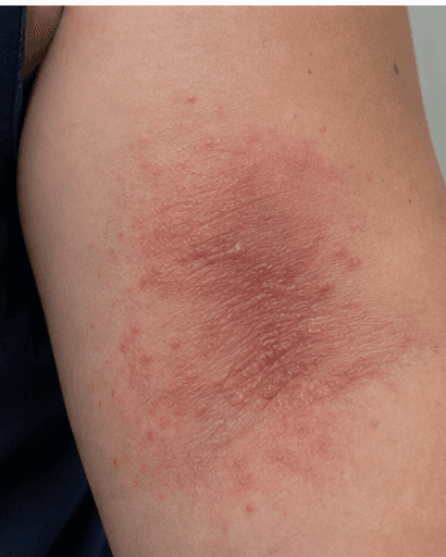 Eczema Management: before