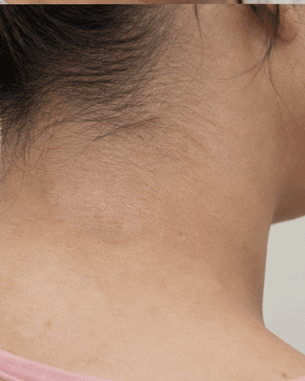 Fungal Infection Treatment: after