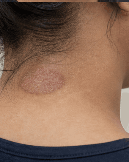 Fungal Infection Treatment: before