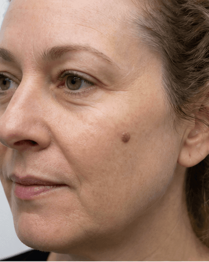 Mole & Skin Check: before