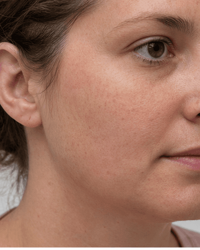 Mole Removal: after