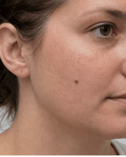 Mole Removal: before