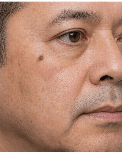 Mole Removal: before
