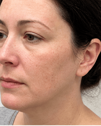 Allergy Patch Testing: after