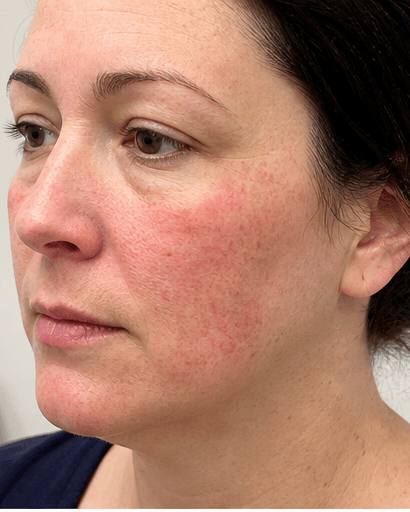 Allergy Patch Testing: before