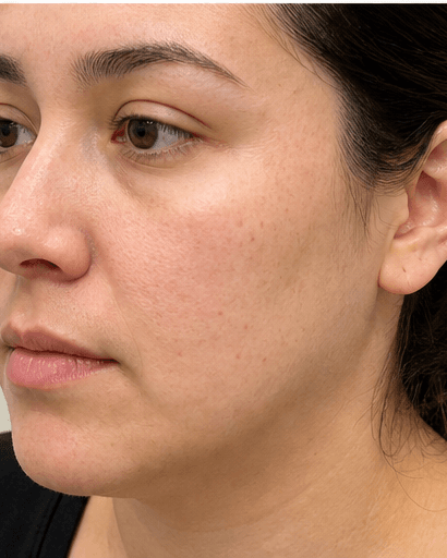 Allergy Patch Testing: after