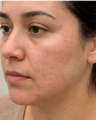 Allergy Patch Testing: before