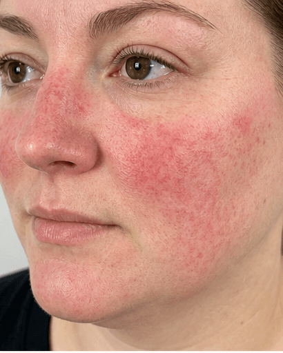 Rosacea Programme: before