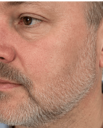 Rosacea Programme: after