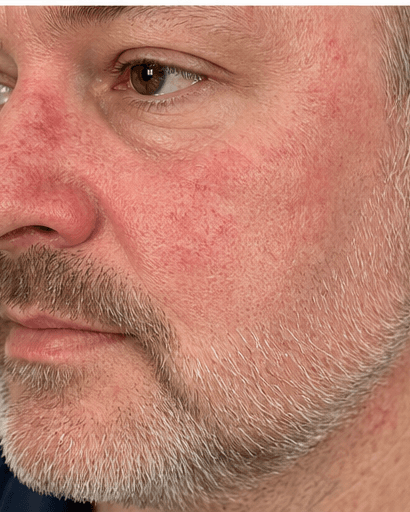 Rosacea Programme: before