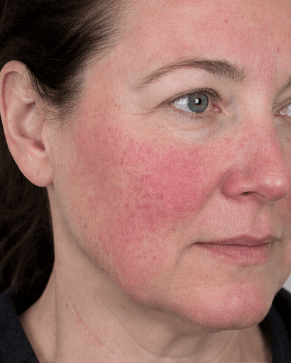 Rosacea Management: before