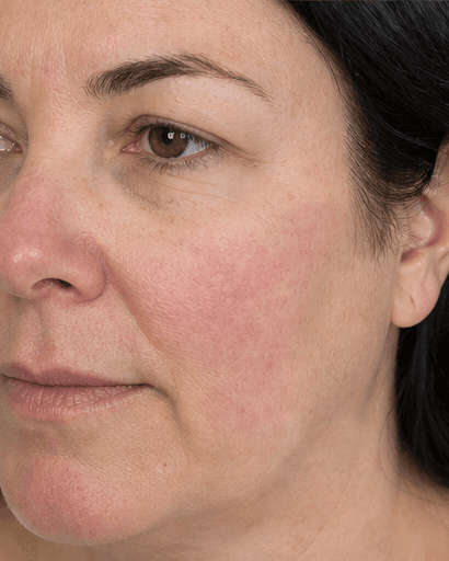 Rosacea Management: after