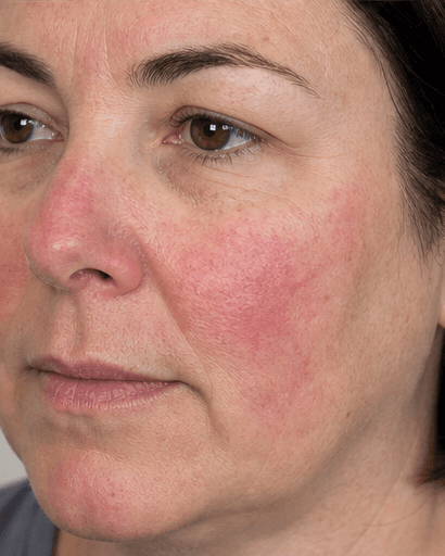 Rosacea Management: before
