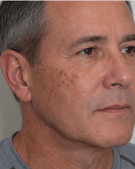 Skin Biopsy: before