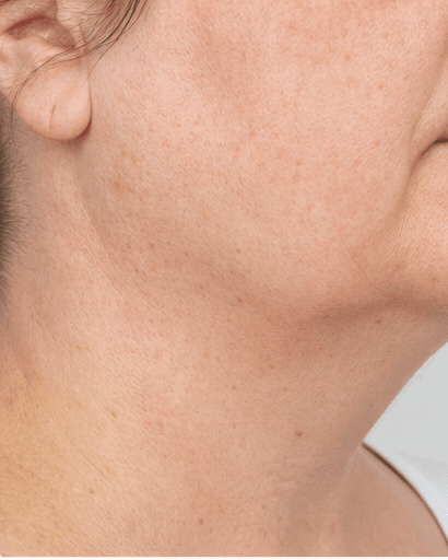 Skin Tag Removal: after