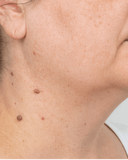 Skin Tag Removal: before