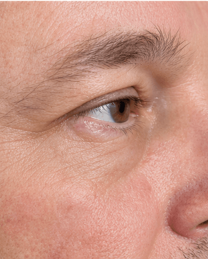 Skin Tag Removal: after