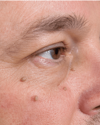 Skin Tag Removal: before
