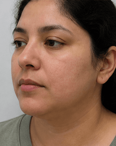 Chronic Hives Workup: after
