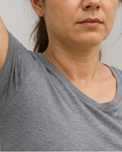 Hyperhidrosis Assessment: after