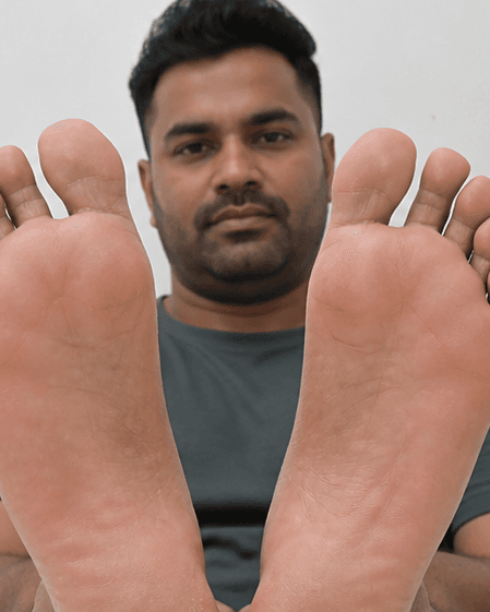 Palms & Soles Treatment: after