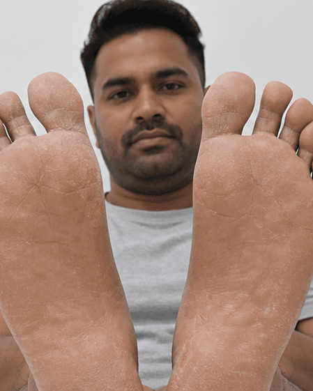 Palms & Soles Treatment: before