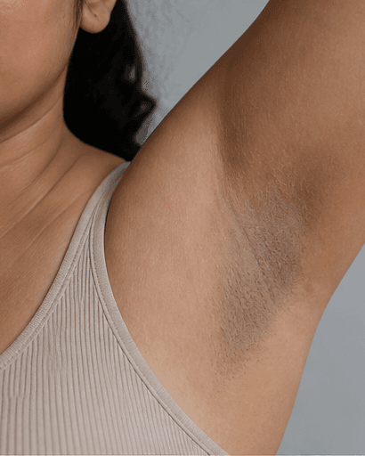 Underarm Treatment: before