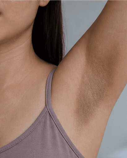 Underarm Treatment: before