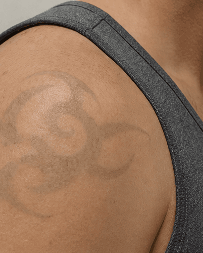 Black Ink Removal: after