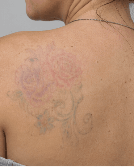 Coloured Tattoo Removal: after