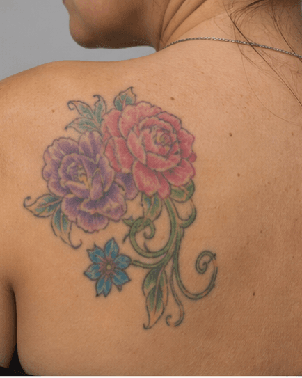 Coloured Tattoo Removal: before
