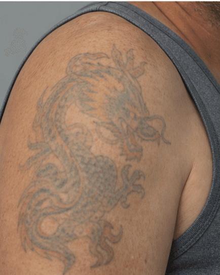 Coloured Tattoo Removal: after