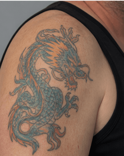 Coloured Tattoo Removal: before