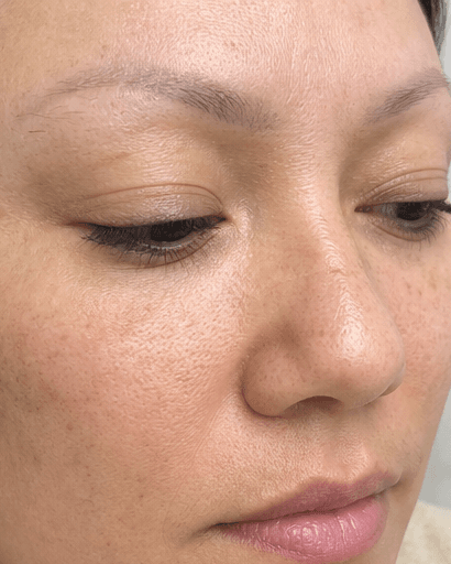 Cosmetic Tattoo Removal: after