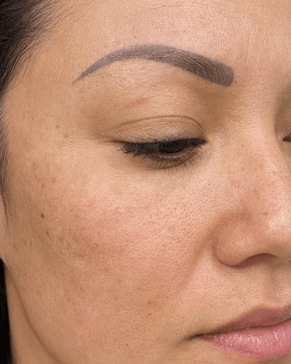 Cosmetic Tattoo Removal: before